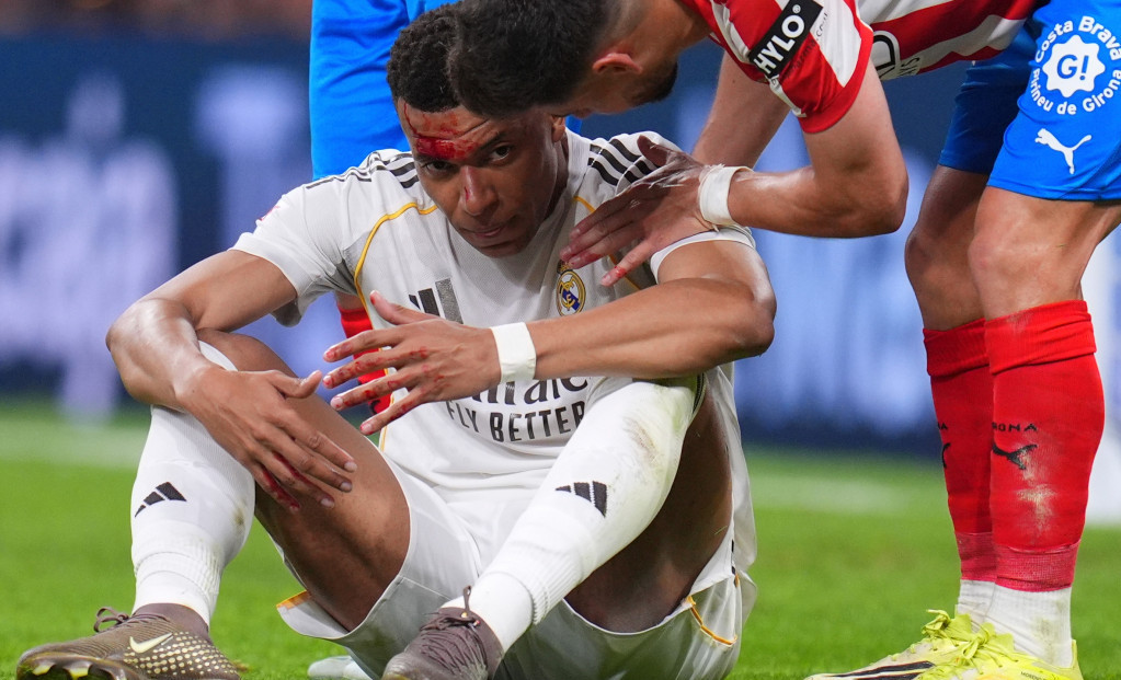 Kilijan Mbape je ostao krvav posle duela gde nije dosuđen penal